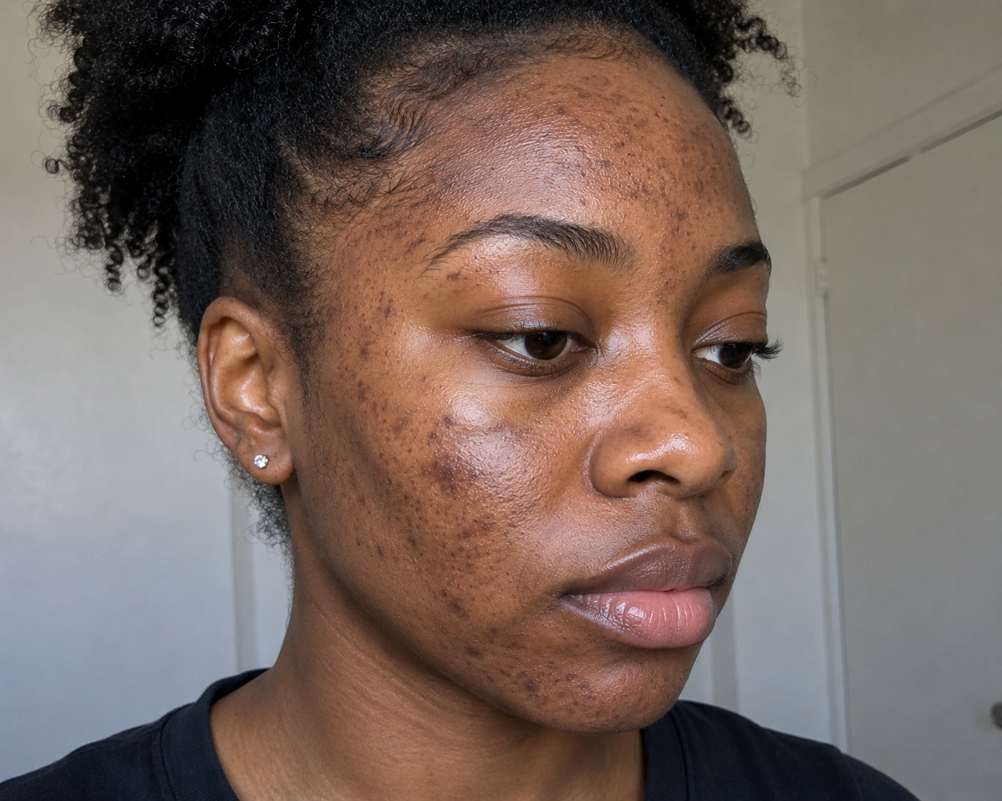 Hyperpigmentation BEFORE